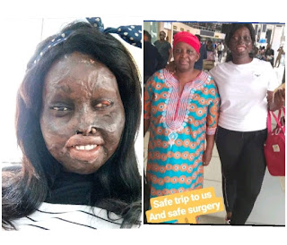 Chizzy frances Acid burn survivor, chizzy frances